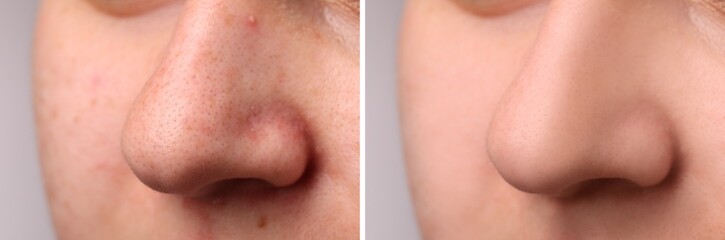 Photos of woman before and after acne treatment, closeup. Collage showing affected and healthy skin