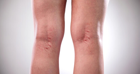 Leg Vein Varicose Spider Treatment