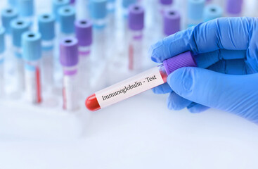 Doctor holding a test blood sample tube with Immunoglobulin test on the background of medical test tubes with analyzes.Banner