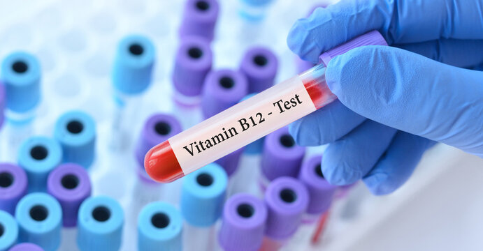 Doctor holding a test blood sample tube with Vitamin B12 test on the background of medical test tubes with analyzes