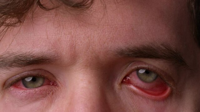Man pulls down eye to show off eye infection - pink eye - then blinks