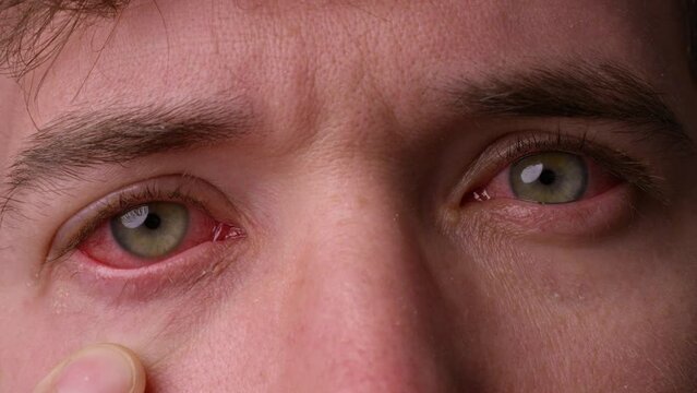 man lookign directly into camera with eye infection - pink eye - painful