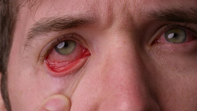 Man pulls down on eye to show pink eye infection to camera - close up on eyes