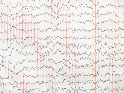 encephalogram on paper - amplitude-integrated electrical activity of brain