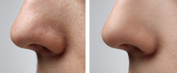 Obraz premium Before and after acne treatment. Photos of woman on light grey background, closeup. Collage showing affected and healthy skin