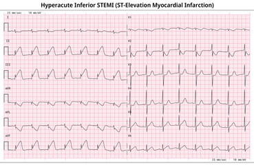 Hyperacute Inferior STEMI (ST-Elevation Myocardial Infarction) - 12 Lead ECG Common Case - 6 Sec/lead - Vectors and Illustrations for Medical Purposes - obrazy, fototapety, plakaty