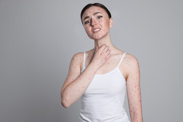 Obraz premium Woman with rash suffering from monkeypox virus on light grey background