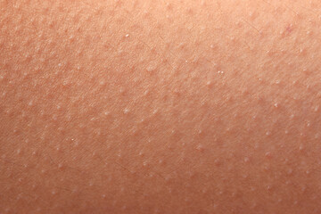 Fototapeta premium skin with cold rash as background.