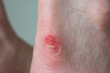 Fototapeta premium Young woman's bruised ankle from uncomfortable shoes. Open wound on the spur, peeling skin, close up macro shot, unrecognizable face