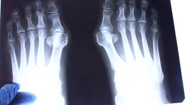 Doctor hands with blue medical x ray scan of feet and toes with Hallux Valgus deformity and pointing pen close up