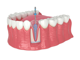 3d render of lower jaw with endodontic rotary file over white background