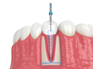 3d render of lower jaw with endodontic rotary file over white background