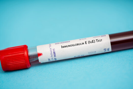 Immunoglobulin E (IgE) Test
