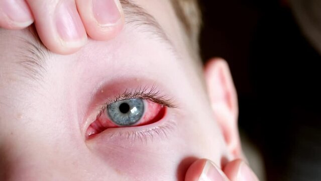 Close-up of boy getting eye drops. Treatment of after flu, cold or allergy close-up
