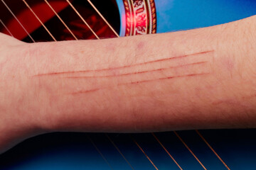 The skin condition after cat scratch and bite of veterinary surgeon hand during physical examination in a veterinary clinic.