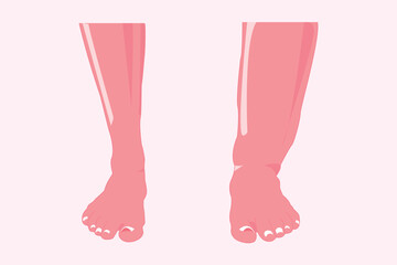 normal and abnormal foot. edema foot illustration for education. vector illustration. eps 10