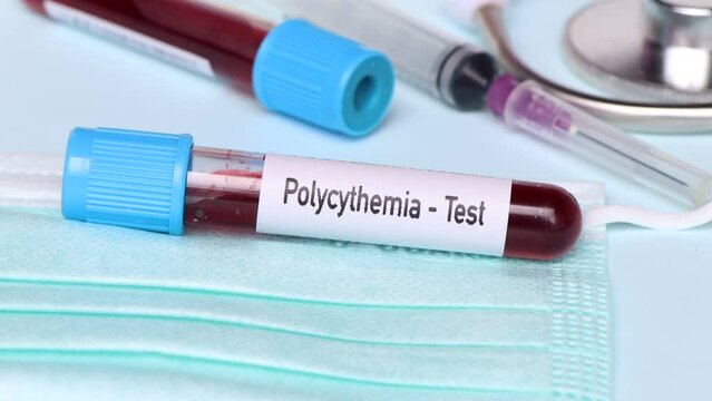 Polycythemia test, blood sample to analyze in the laboratory, blood in test tube