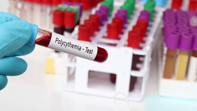 Polycythemia test, blood sample to analyze in the laboratory, blood in test tube