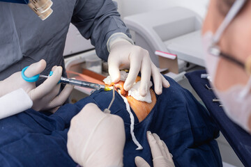 A cosmetic surgeon injects local anesthesia into the nose prior to an open rhinoplasty procedure, while a nurse stands by with a nasal aspirator.