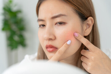 Young woman asian are worried about faces Dermatology and allergic to steroids in cosmetics. sensitive skin, red face from sunburn, acne, allergic to chemicals, rash on face. skin problems and beauty