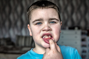Boy showing a fallen tooth. Loss of teeth, concept of dental problems
