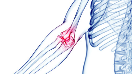 3d medical illustration of elbow pain - obrazy, fototapety, plakaty
