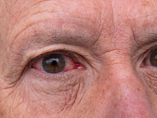 Naklejka premium Closeup of irritated red bloodshot eye known as a hyphema - accumulation of red blood cells.