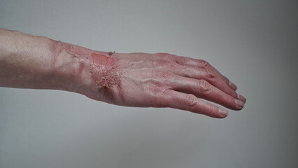 Fototapeta premium Close-up of a woman's hand with a burst blister from a boiled water burn, broken skin, 1st or 2nd degree burn. Painful wound. Thermal burn. Skin peels off after a burn, wound treatment. macro photo