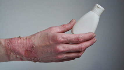 mockup bottle with cream healing ointment woman hand burned with boiling water with burst blister,damaged skin,1st or 2nd degree burns.Painful wound.Thermal burn.skin flaky after burn,treatment wounds