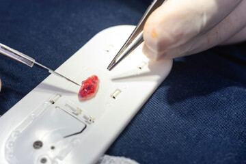 A cosmetic surgeon cuts and shapes a piece of ear cartilage to be used for tip plasty operation.