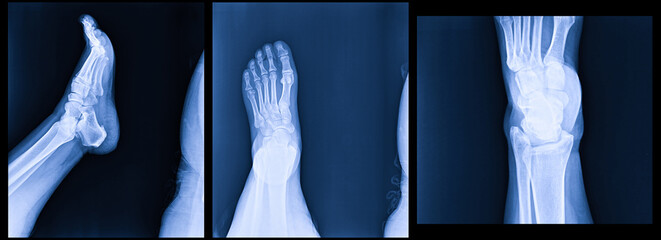 X-ray normal human's foot lateral