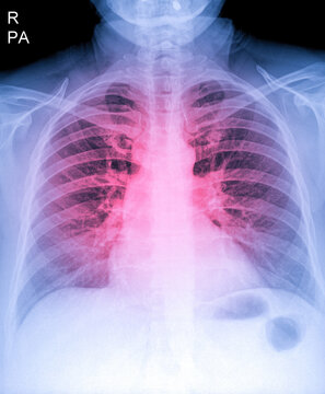 X-Ray Image Of Human Chest for a medical diagnosis, shows pain area with red. Thorax x-ray for lungs examination, PA up right