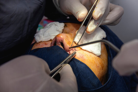 A cosmetic surgeon closing the cut alar area with sutures. An alarplasty or alar trimming or reduction procedure.