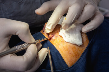A cosmetic surgeon makes an incision at the alar crease of the nose. An alarplasty or alar trimming...