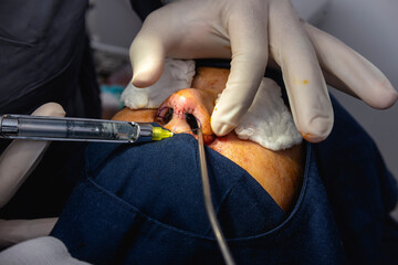 A cosmetic surgeon injects the ala of the nose with local anesthesia numb the area prior to an alarplasty procedure.