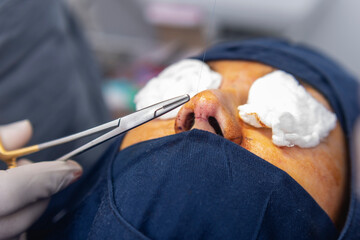 A cosmetic surgeon closes the incision area with surgical sutures. Aided with a pair of medical...