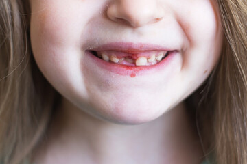 A little cute girl lost her front baby milk tooth. Lost temporary tooth.