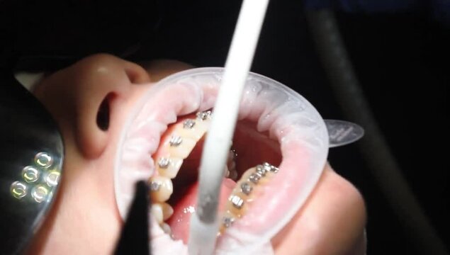 orthodontist using dental tools while cleaning teeth of patient wearing brackets