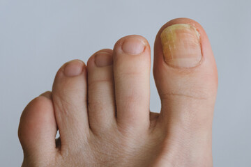 Toenails affected by fungal infection. Onychomycosis