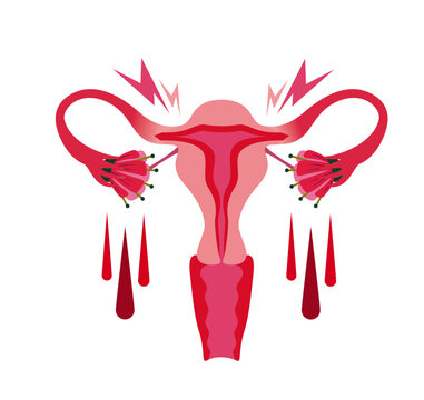 Vector illustration on a white background of endometriosis. With blood, cramps and pain. 