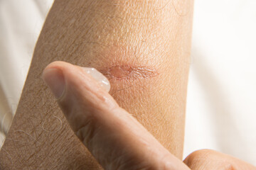 Man applying ointment to a small minor first degree burn on his forearm
