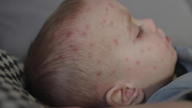 sick baby toddler child suffering from chickenpox symptoms lying sofa fever pimples blister face. varicella virus on kid's portrait first symptoms of pox sickness. pediatric dermatology skin problem 