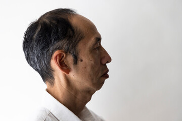 Fototapeta premium 大きなシミがある日本人中年男性の横顔 