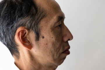 Obraz premium 大きなシミがある日本人中年男性の横顔 より