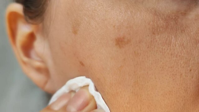 A woman rubs her skin with a sponge. Pigmented spots on the face. Care procedures, lotion. Close-up video.