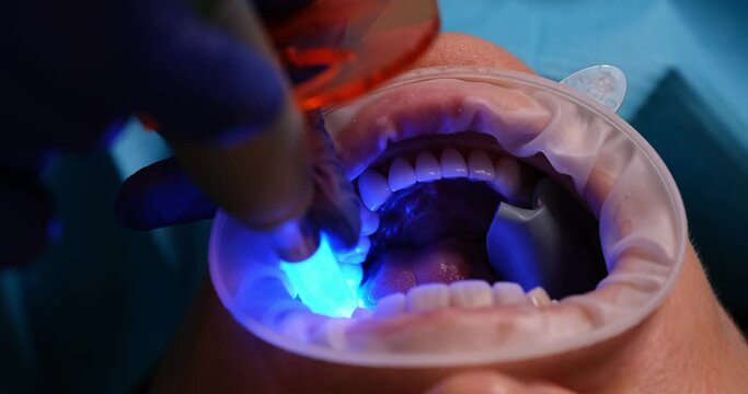 Professional dentist treats teeth of female patient with innovative equipment. Specialist does dental procedure for woman oral cavity in clinic