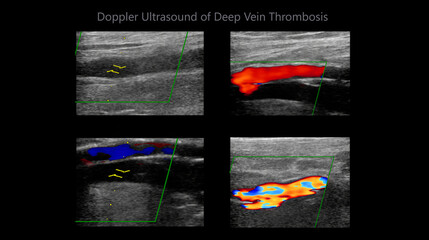 Color Doppler ultrasound determination in deep vein thrombosis patients for finding  deep vein thrombosis of lower extremity. - obrazy, fototapety, plakaty