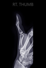 x-raiy image of thumb finger.