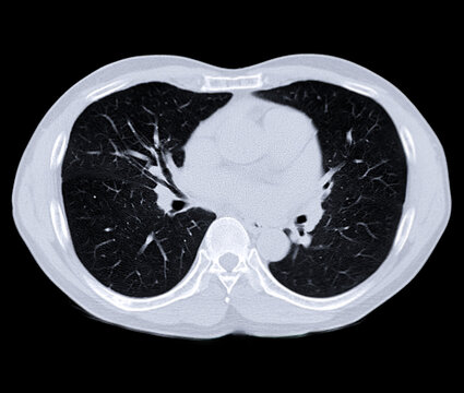 CT Scan Of Chest Or Lung For Screening Lung Nodules And Lung Cancer .