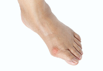 Closeup inflammation of deform bunion joint in big toe bone. Hallux valgus, bunion in foot isolated on white background.